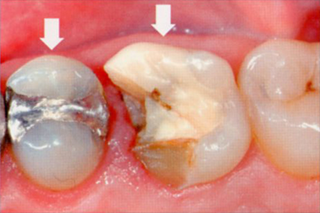 オールセラミック