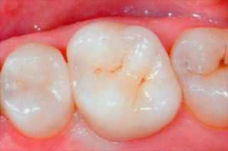 オールセラミック