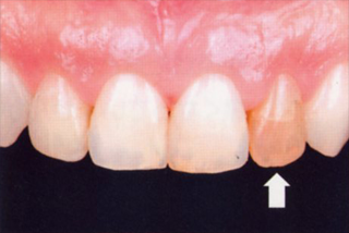 オールセラミック