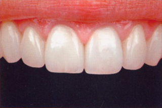 オールセラミック