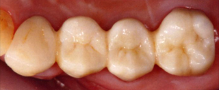 オールジルコニア